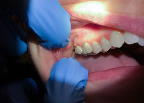 Best Knocked-Out Tooth Emergency  in Perry, KS